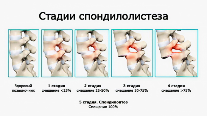 Смещение позвонков грудного отдела. Симптомы, лечение, упражнения