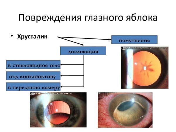 Ушиб (травма) глаза. Первая помощь, классификация, лечение