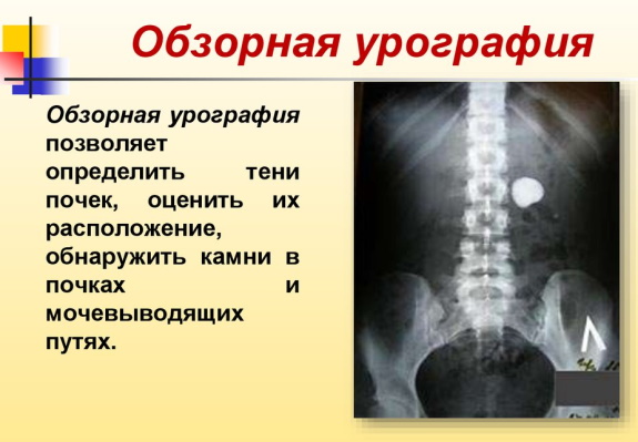 Внутривенная урография почек с применением контрастного вещества