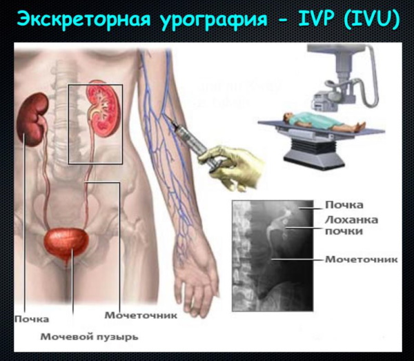 Внутривенная урография почек с применением контрастного вещества