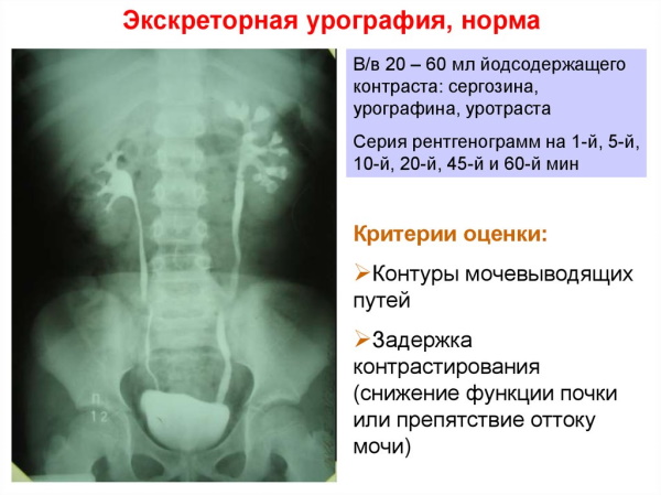 Внутривенная урография почек с применением контрастного вещества