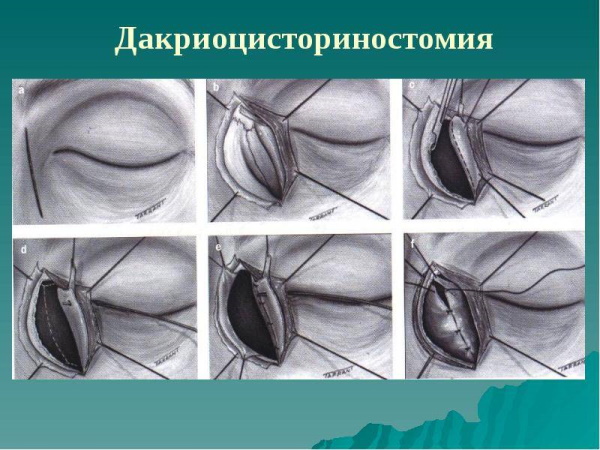 Воспаление слезного канала. Лечение ребенка, взрослого