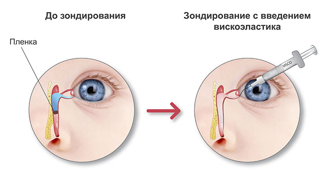 Воспаление слезного канала. Лечение ребенка, взрослого