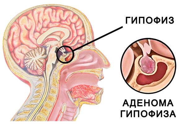 Аденома гипофиза. Симптомы, что это такое, прогноз