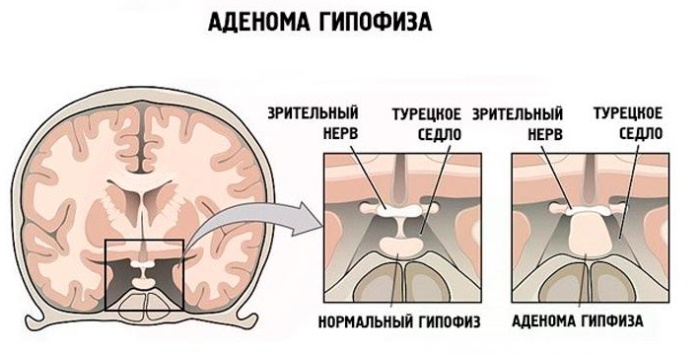 Аденома гипофиза. Симптомы, что это такое, прогноз