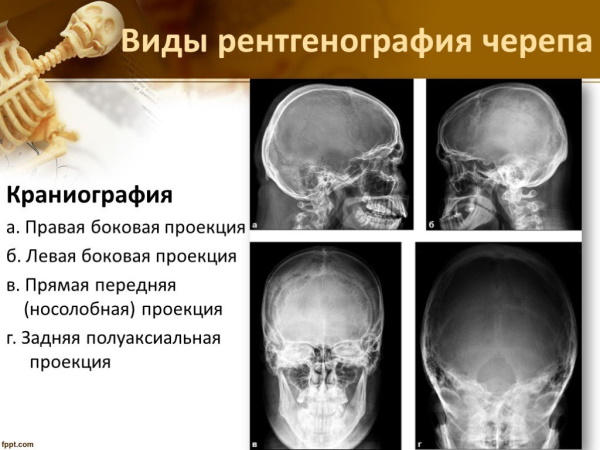 Аденома гипофиза. Симптомы, что это такое, прогноз