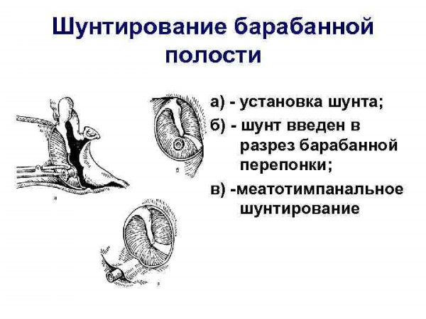 Гнойный отит у ребенка. Симптомы, лечение, капли