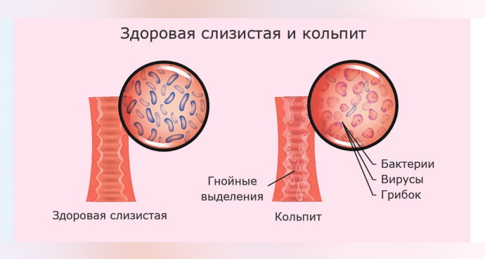 Кандидозный кольпит (вагинит). Лечение у женщин, клинические рекомендации