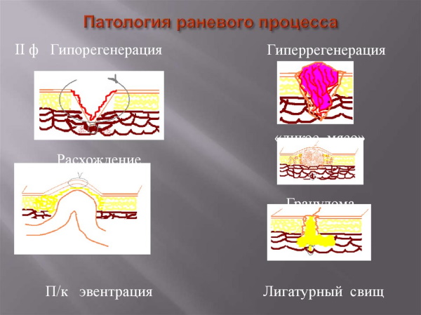 Лигатурный свищ после кесарева. Что это, фото, симптомы