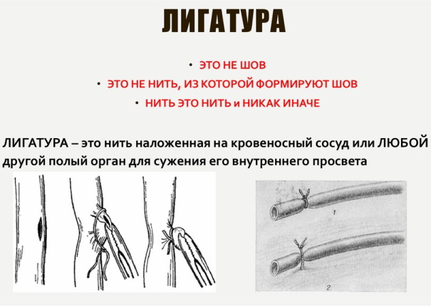 Лигатурный свищ после кесарева. Что это, фото, симптомы