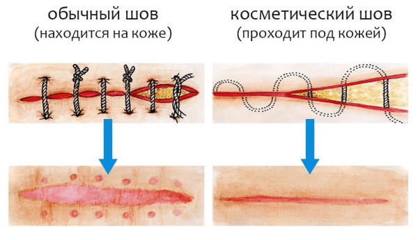 Лигатурный свищ после кесарева. Что это, фото, симптомы