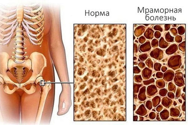 Остеопетроз что за болезнь у детей. Симптомы и лечение