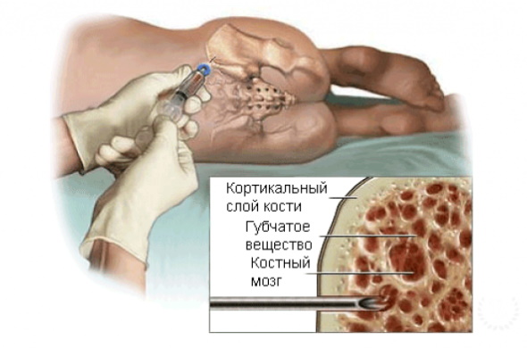 Остеопетроз что за болезнь у детей. Симптомы и лечение