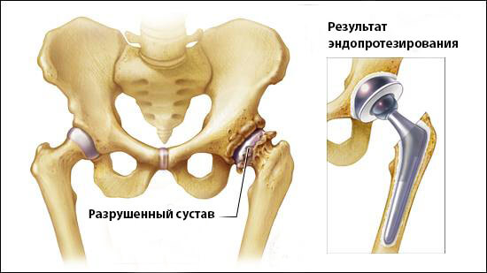 Остеопетроз что за болезнь у детей. Симптомы и лечение