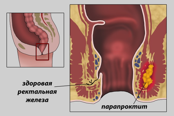 Парапроктит после операции. Заживление, реабилитация, лечение