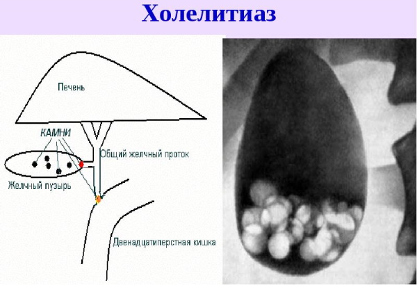 Препараты урсодезоксихолевой кислоты. Список