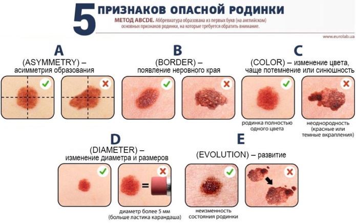 Родинка чешется. Причины у женщины, что делать