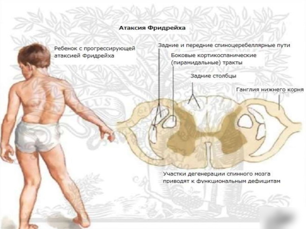 Шаткость (шаткая походка). Причины, лечение в пожилом возрасте