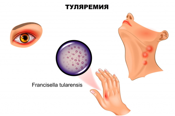 Туляремия. Возбудитель заболевания, симптомы, лечение